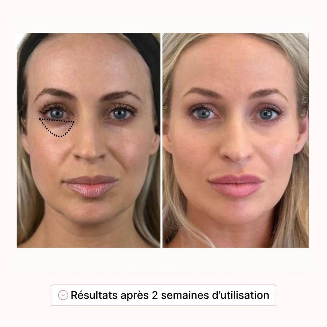 Protocole Regard 4-en-1 Baia® Stylo LED & Sérum Activateur